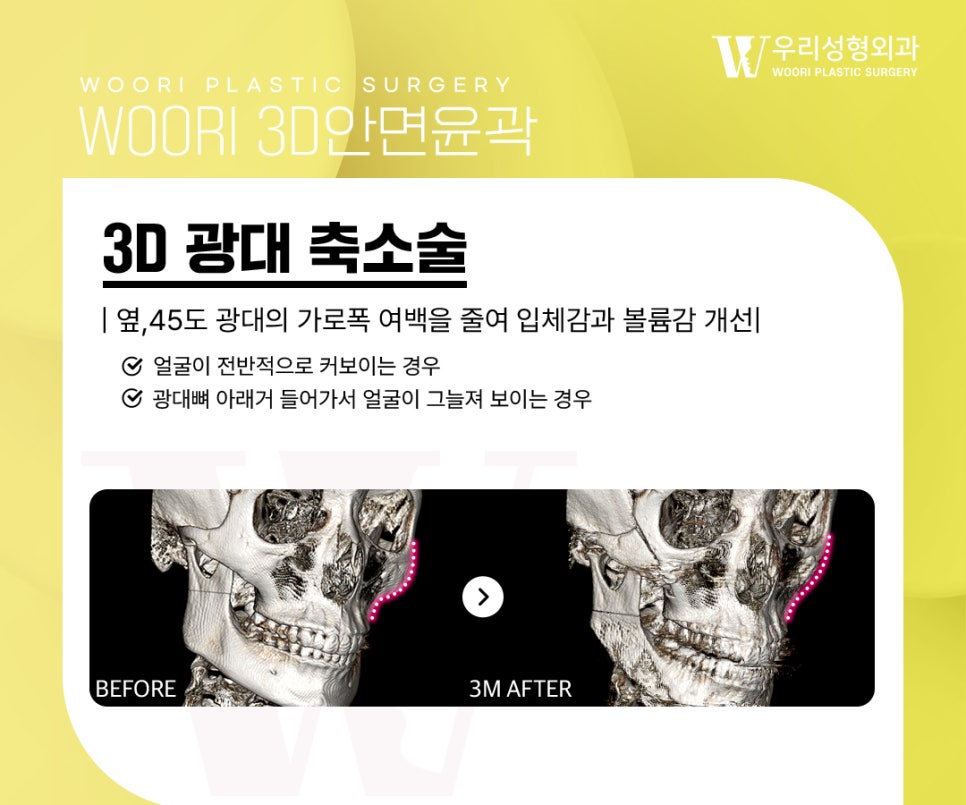 What to Check When Considering Square Jaw Surgery image 3