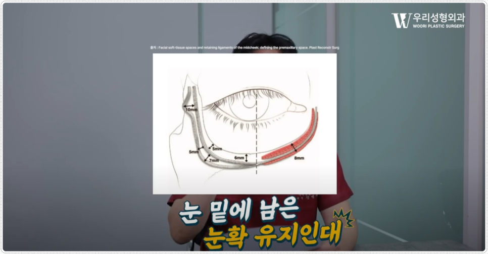 눈밑지방재배치 부작용 알아볼까요 관련 이미지 2