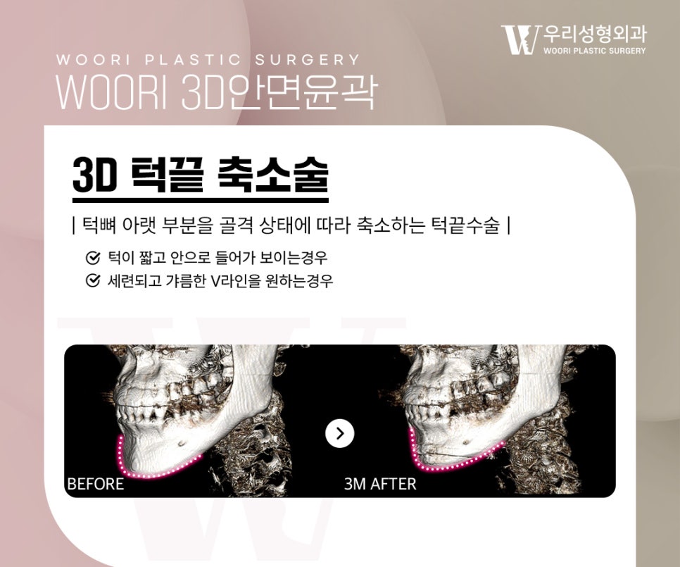 윤곽수술 사각턱·광대·턱끝을 함께 살펴보기 관련 이미지 5
