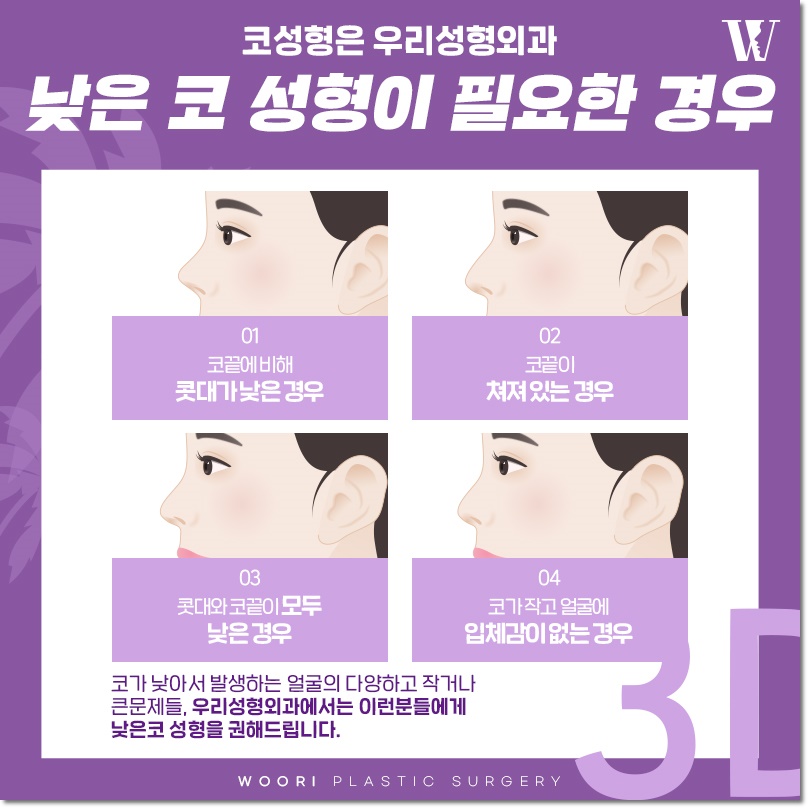 남자 코성형 가격 기능코 차이 관련 이미지 6