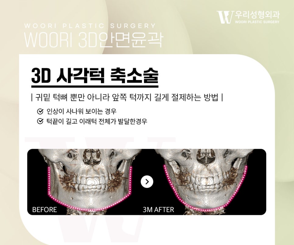 윤곽수술 얼굴형의 균형을 고려한 안면윤곽 방법 관련 이미지 2