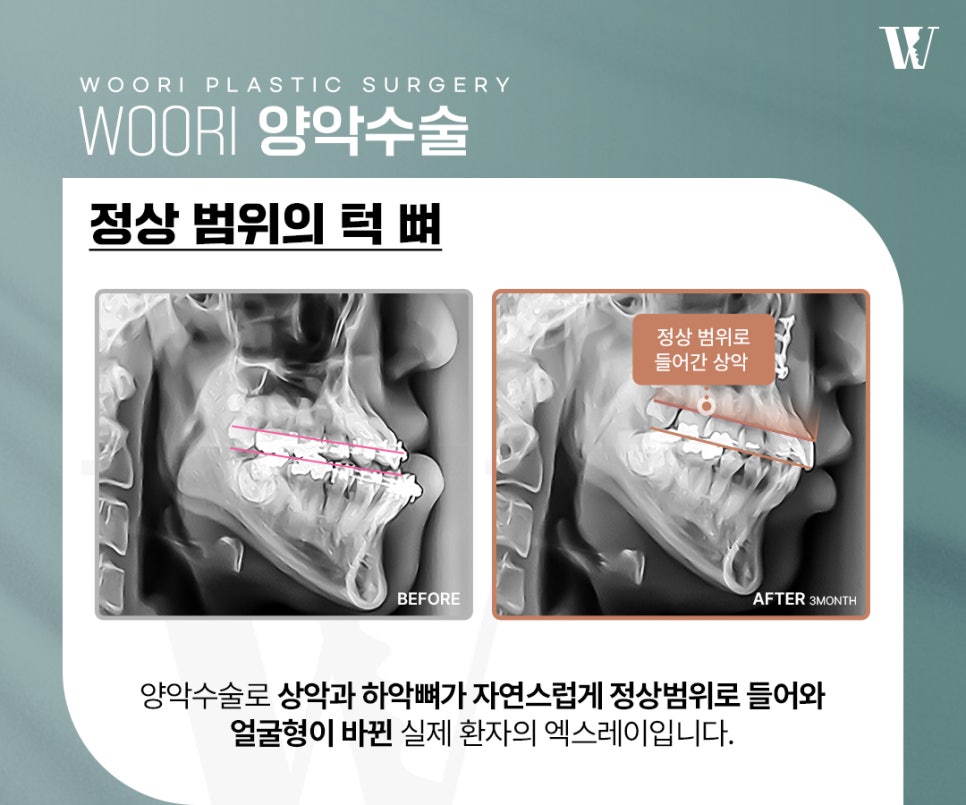 양악수술 얼굴의 중심을 맞추는 과정 관련 이미지 4