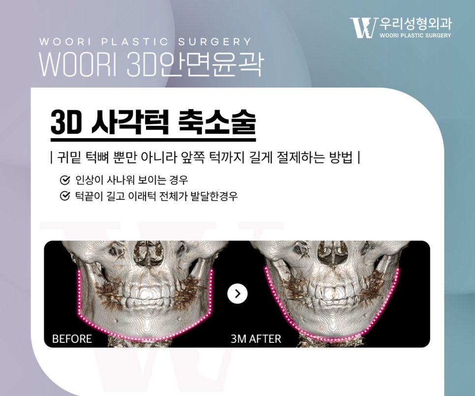 광대축소술 얼굴이 커 보이는 이유가 광대 때문일 수 있습니다 관련 이미지 3