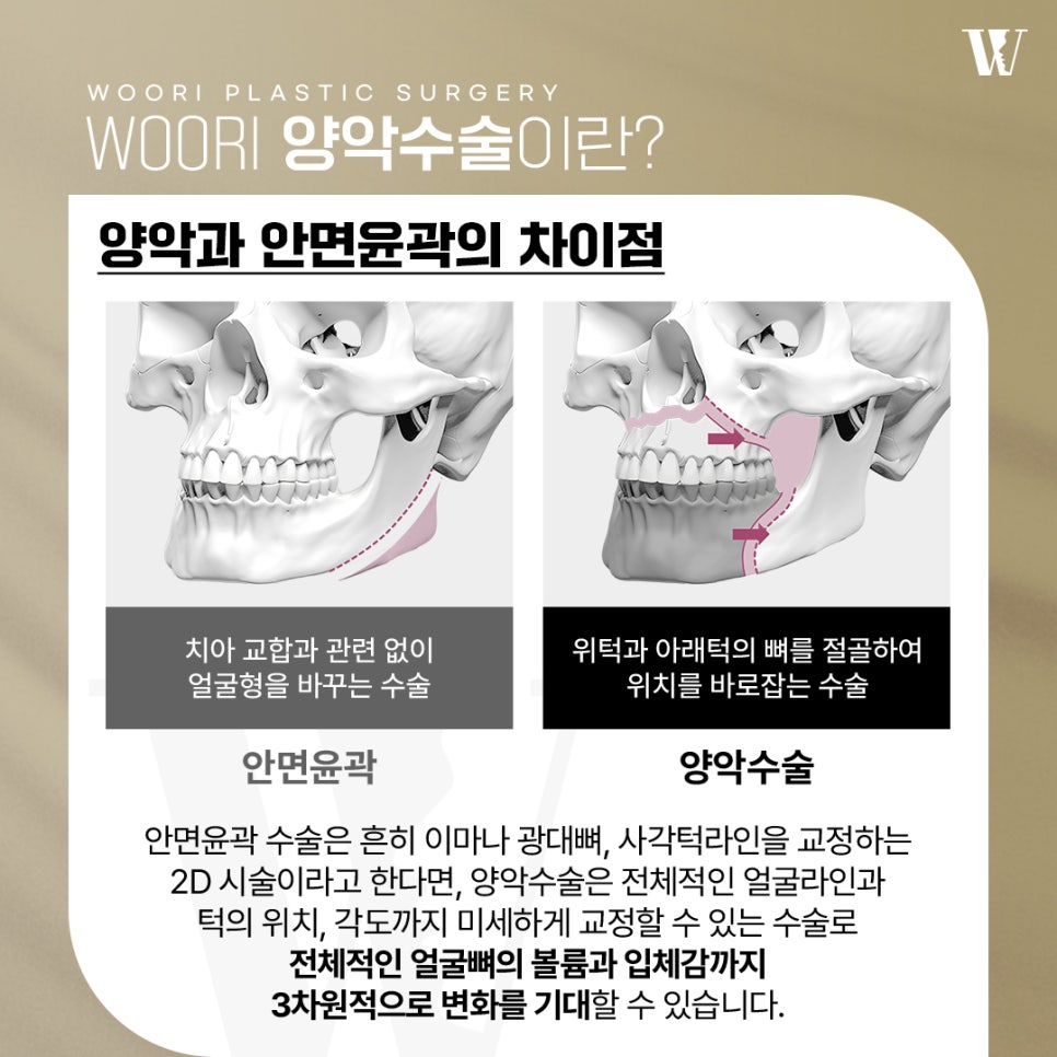 양악수술 안면윤곽수술과의 차이점과 수술 방법 관련 이미지 2