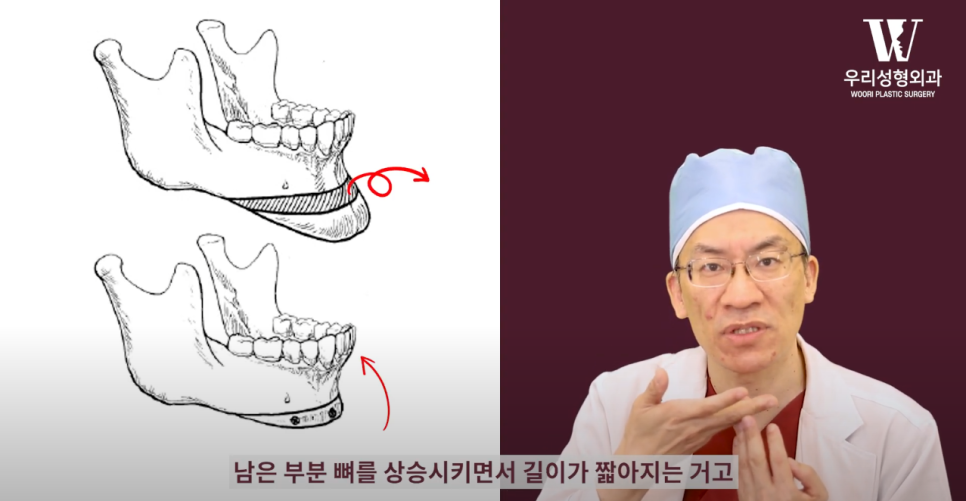 우리성형외과 임평진 원장 긴 얼굴 어떻게 줄일까?! 얼굴 짧아지는 2가지 방법! 관련 이미지 9