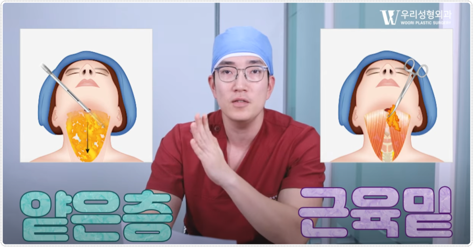 이중턱살 시술 근육묶기는 해야할까요? 관련 이미지 2