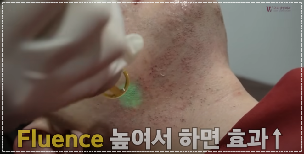 수염 레이저제모 주기 젠틀프로맥스 알아보기 관련 이미지 4