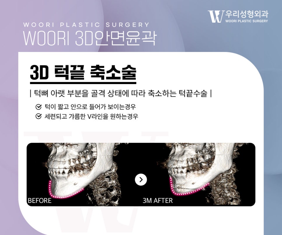 광대축소술 후 처짐이 걱정된다면 고정 방법을 확인해야 하는 이유 관련 이미지 5