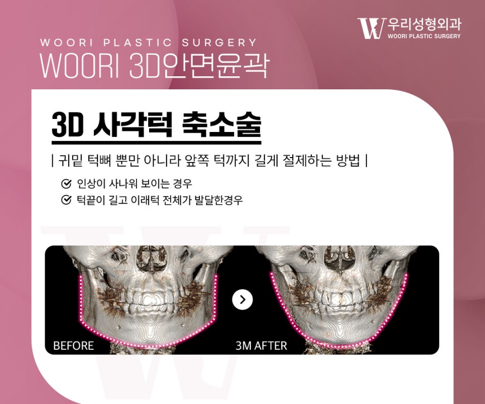 안면윤곽 수술 어떤 차이가 있을까 관련 이미지 2