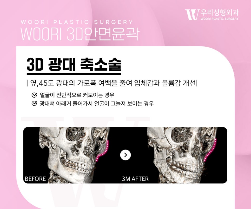 안면윤곽수술 구조 이해하기, 종류부터 주의사항 관련 이미지 3