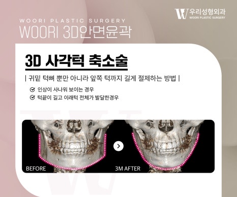 윤곽수술 사각턱·광대·턱끝을 함께 살펴보기 관련 이미지 3
