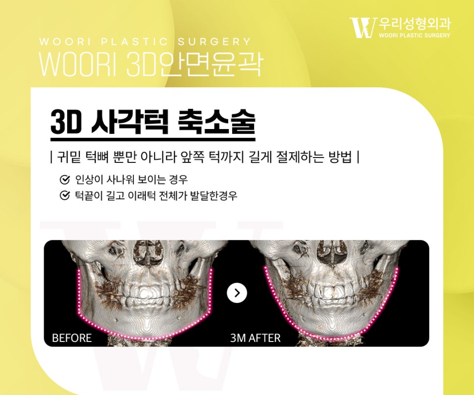 What to Check When Considering Square Jaw Surgery image 2