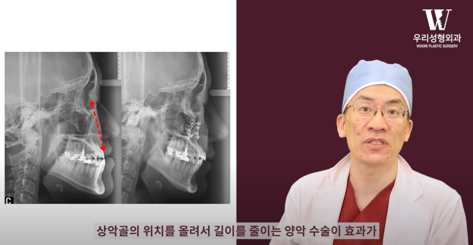우리성형외과 임평진 원장 긴 얼굴 어떻게 줄일까?! 얼굴 짧아지는 2가지 방법! 관련 이미지 6