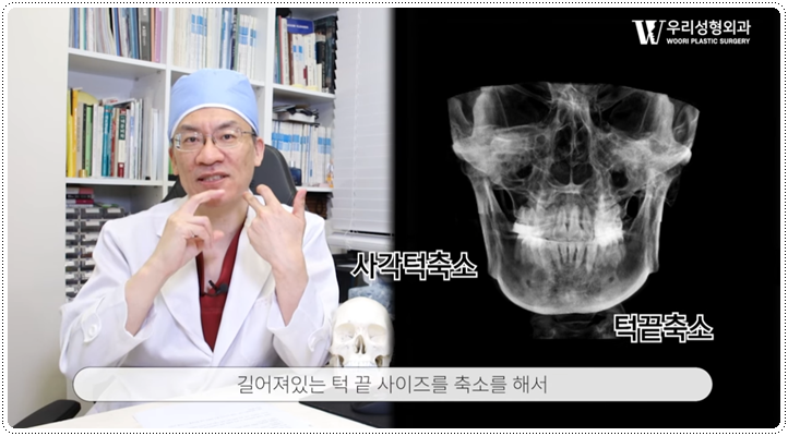 안면윤곽수술방법 땅콩형 얼굴은? 관련 이미지 4