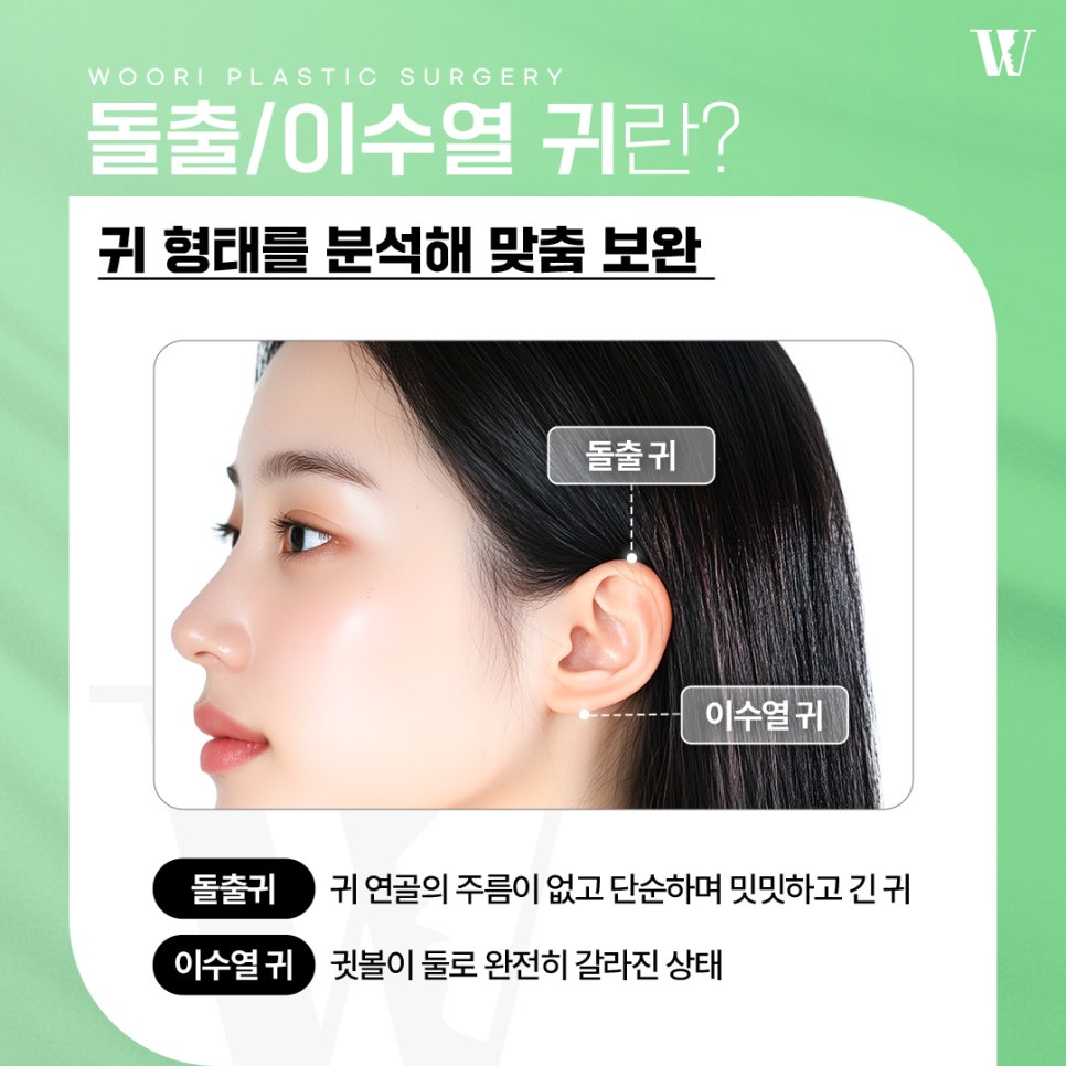 원숭이귀 교정 인상 변화가 크게 느껴지는 이유 관련 이미지 2