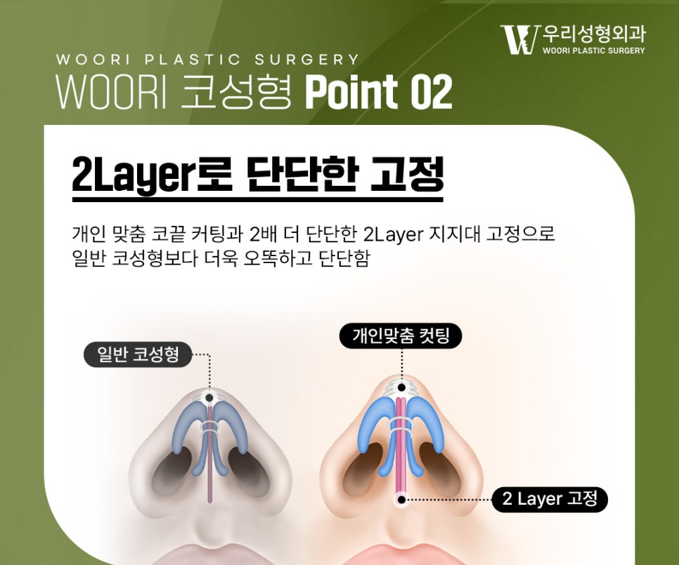 코성형 전 체크해 보세요! 관련 이미지 4