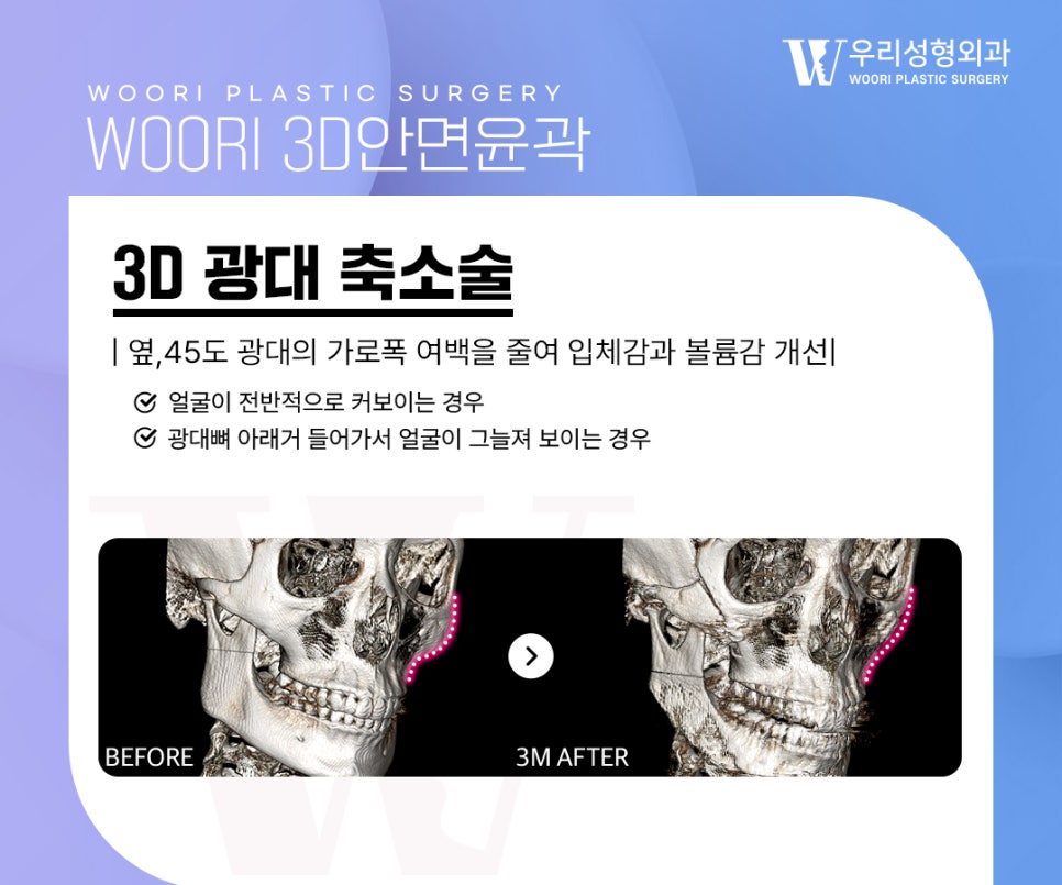 안면윤곽수술 얼굴 라인과 비율을 함께 보는 이유 관련 이미지 4