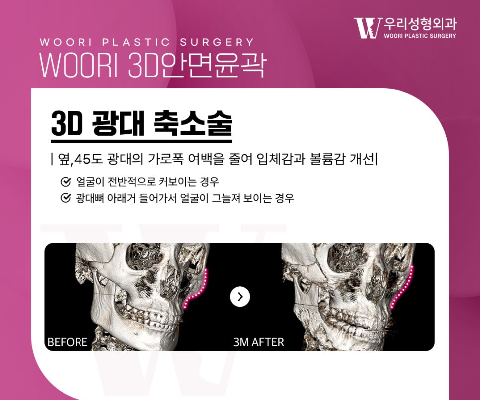 옆광대축소 후 자연스러운 얼굴라인을 만들려면? 관련 이미지 2