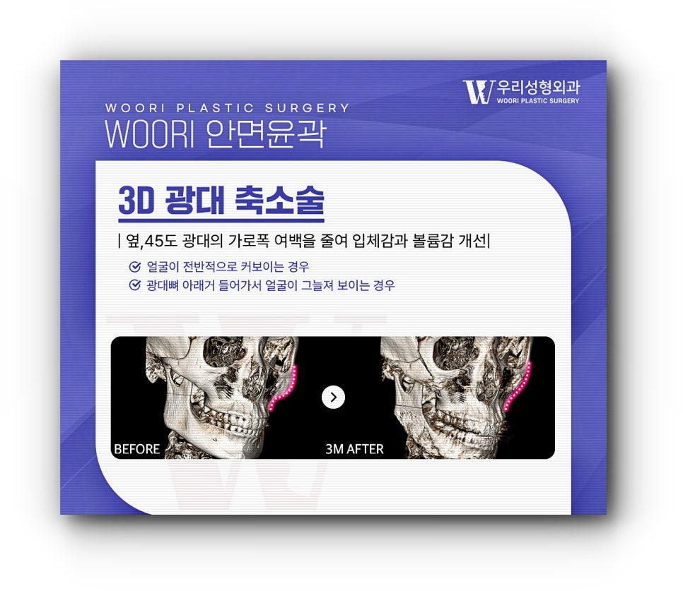 안면윤곽 3종 얼굴형에 큰 변화를 관련 이미지 4