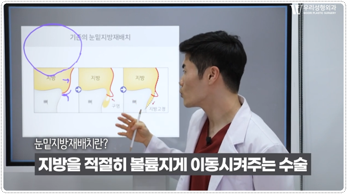 눈밑지방재배치 격막강화술이란 무엇일까 관련 이미지 3