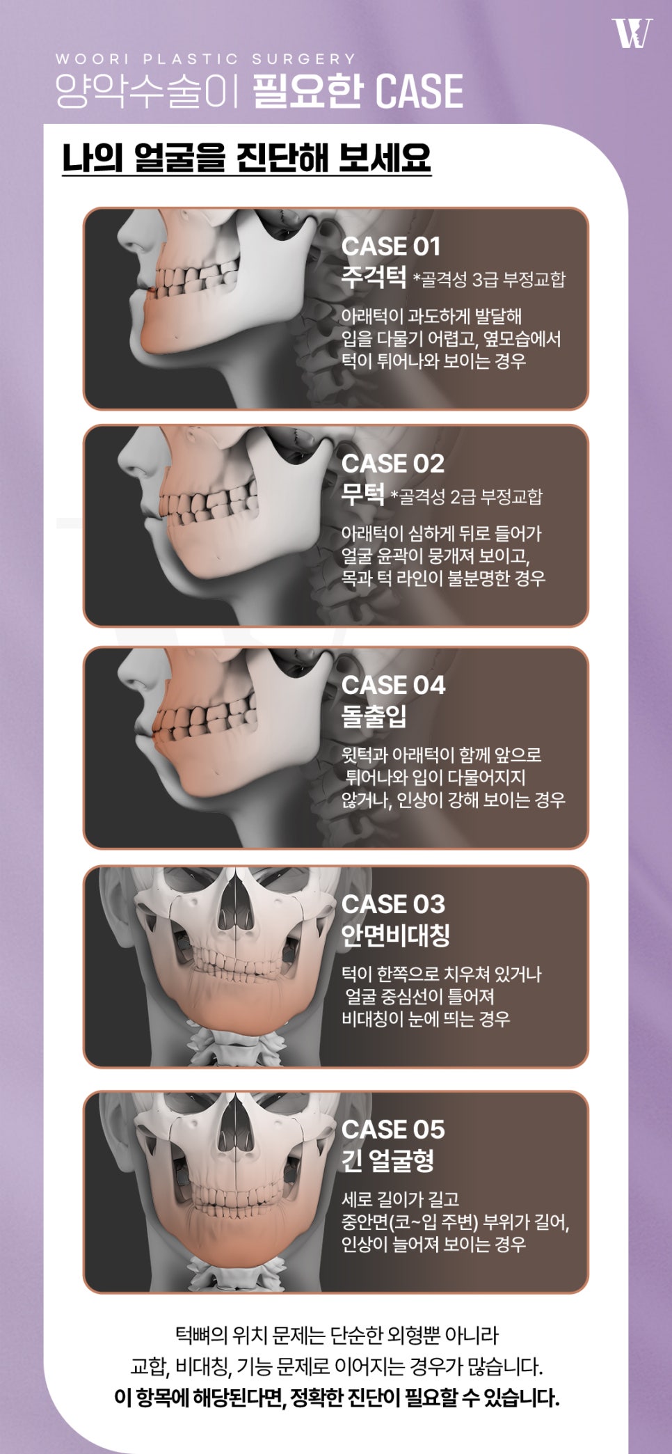 양악수술후기 주걱턱 돌출입 비대칭 케이스별 변화! 관련 이미지 4