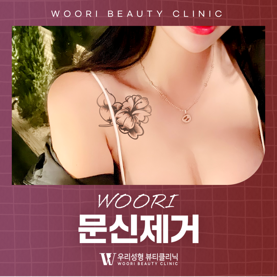 타투제거병원 지우는 원리부터 회복 과정까지 알아보자 관련 이미지 1