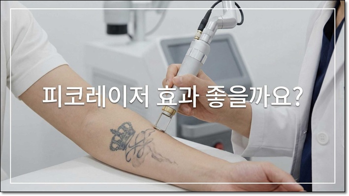 타투제거후기 피코레이저로 해야하는 이유 관련 이미지 1