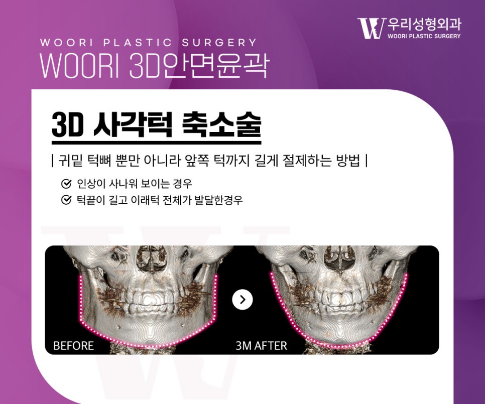 Facial Contouring Review: Do Square Jaw, Cheekbone, and Chin-Tip Surgery Have to Be Done Together? image 2