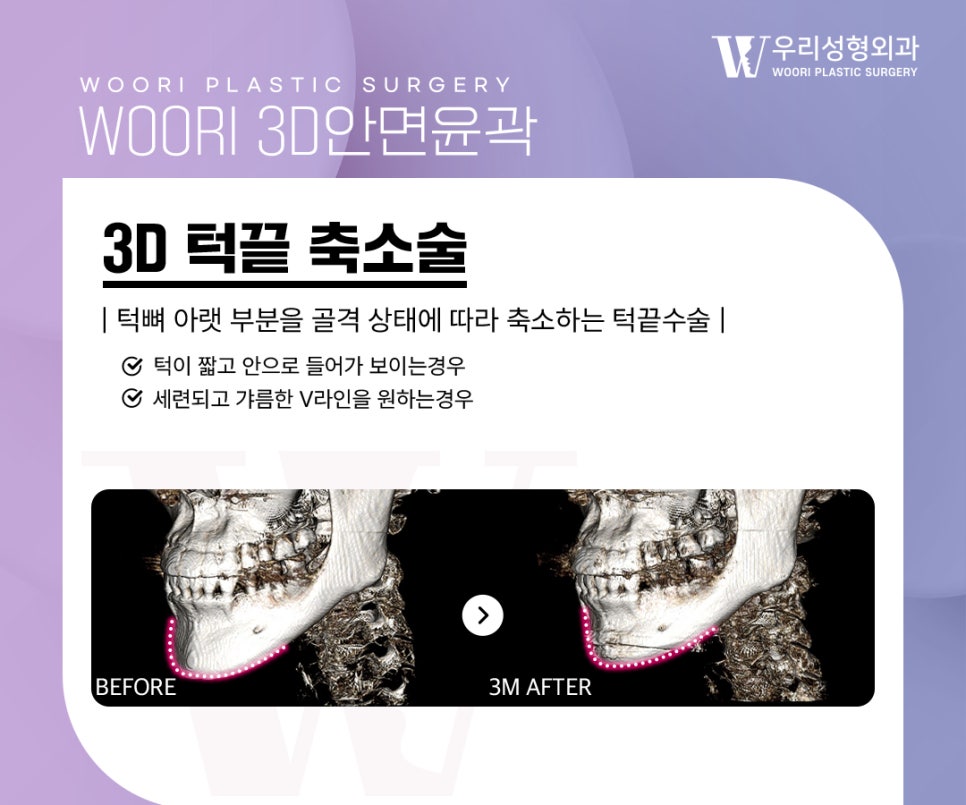 윤곽수술로 얼굴이 작아 보이는 이유는 무엇일까 관련 이미지 4