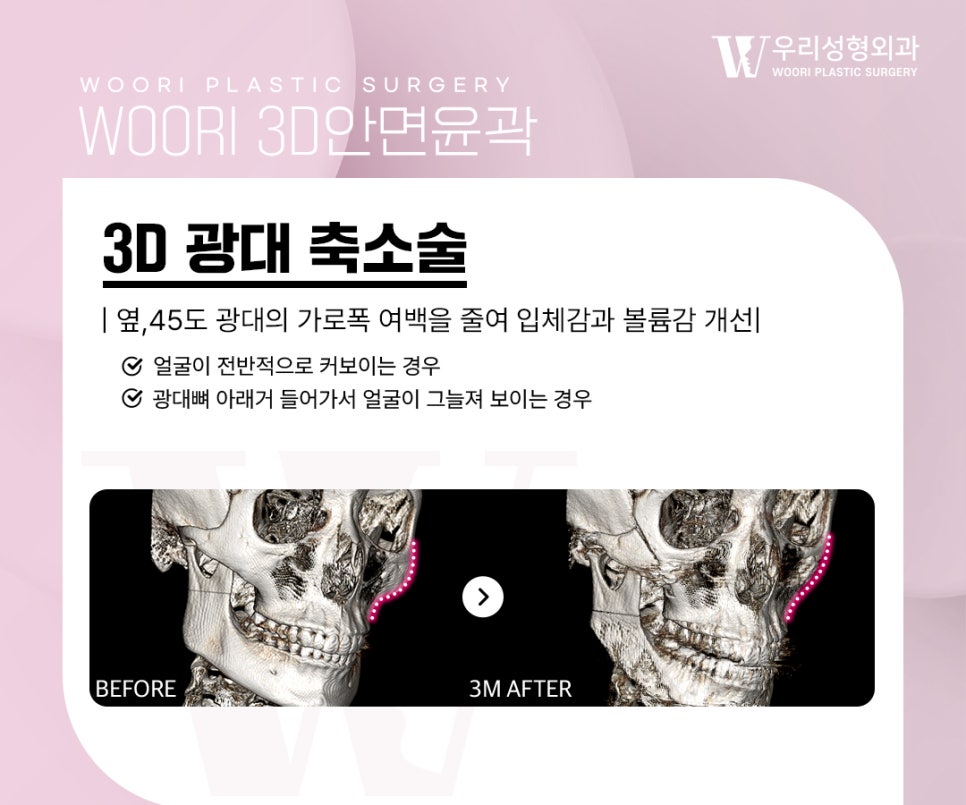 Key Points of Facial Contouring Surgery for Improving the Cheekbone Line image 3