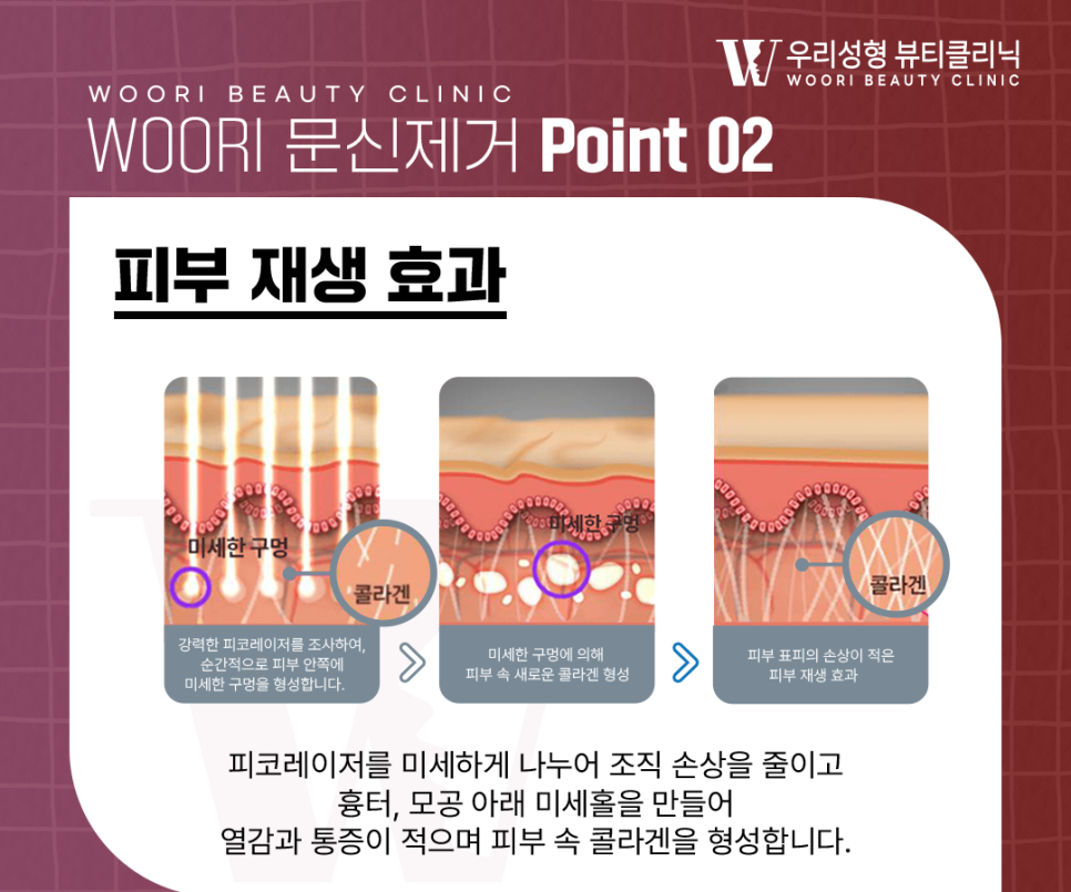 타투제거병원 지우는 원리부터 회복 과정까지 알아보자 관련 이미지 4