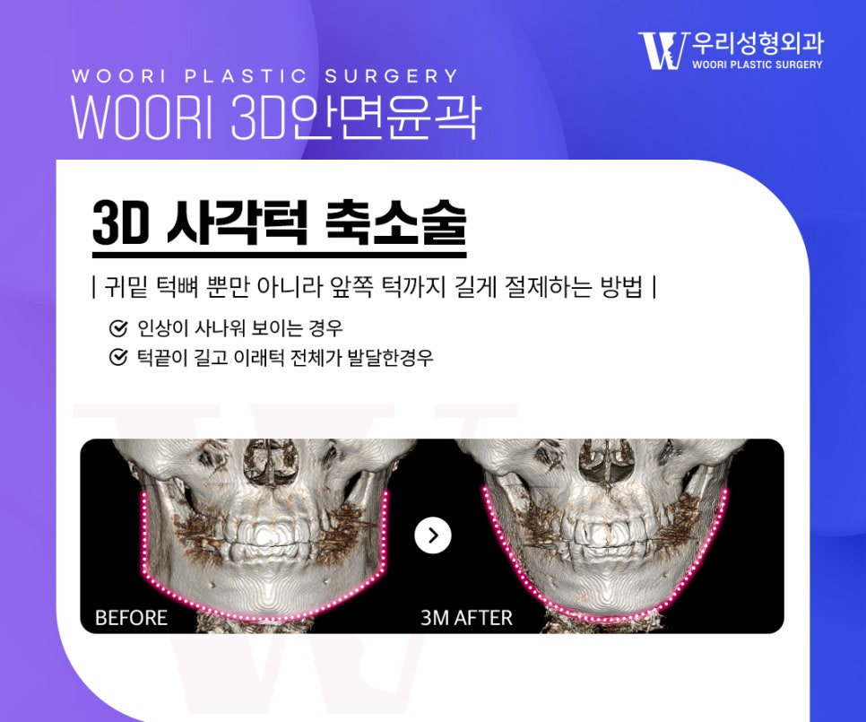 안면윤곽후기 얼굴형 고민에 맞는 축소 부위는 관련 이미지 2