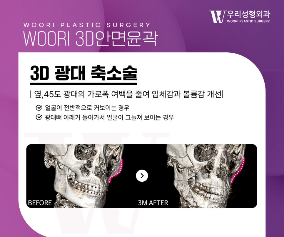 Facial Contouring Review: Do Square Jaw, Cheekbone, and Chin-Tip Surgery Have to Be Done Together? image 3