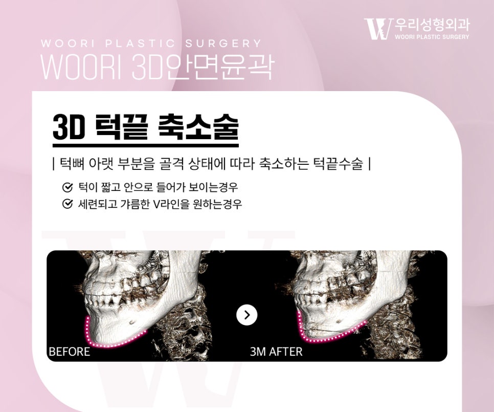 Key Points of Facial Contouring Surgery for Improving the Cheekbone Line image 5