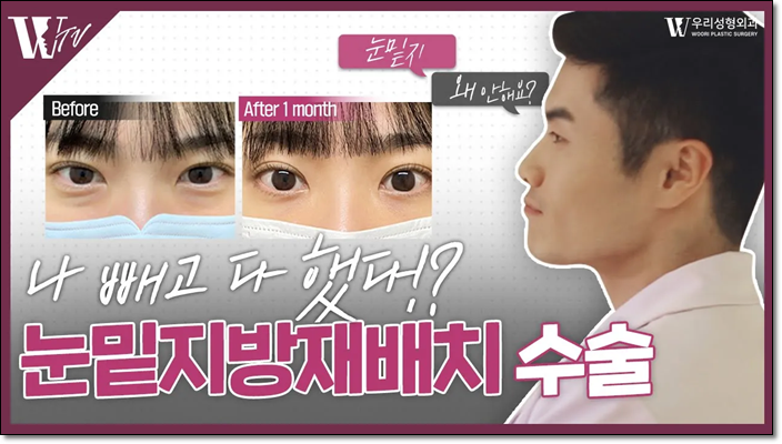 눈밑지방재배치 20대 상담이 많아진 이유 관련 이미지 1