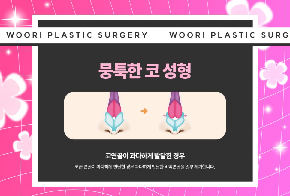휜 코성형 방법과 코 수술 비용, 가격 궁금하다면 관련 이미지 5