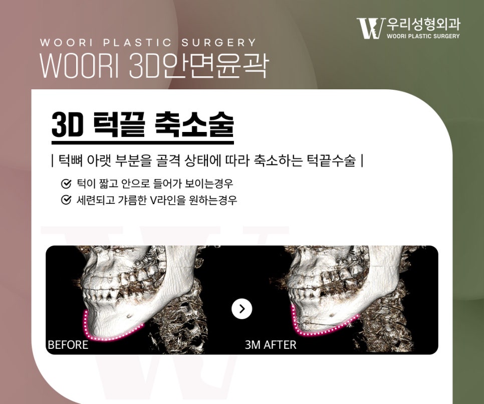 안면윤곽수술 3종을 함께 하는 이유는 무엇일까요? 관련 이미지 4