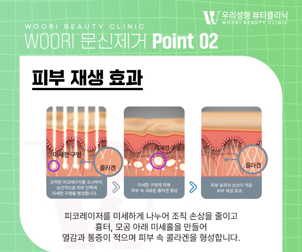 눈썹문신제거 한 번의 레이저로 지울 수 있을까요? 관련 이미지 4