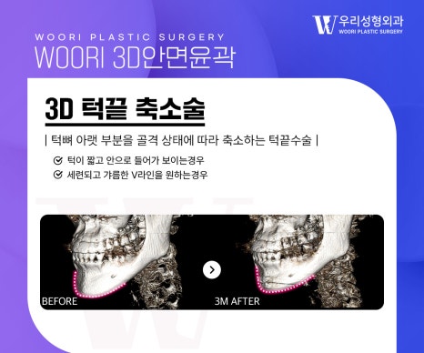 안면윤곽후기 얼굴형 고민에 맞는 축소 부위는 관련 이미지 4