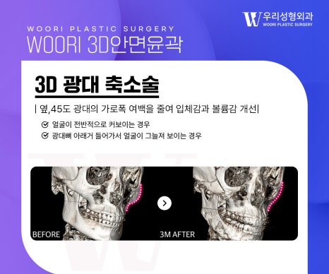 안면윤곽후기 얼굴형 고민에 맞는 축소 부위는 관련 이미지 3