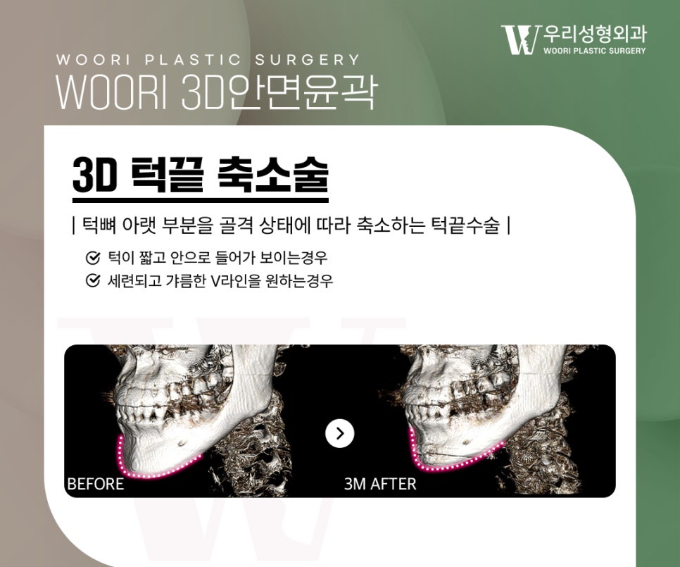 안면윤곽수술 이런 얼굴형이라면 고려해볼 수 있어요 관련 이미지 4