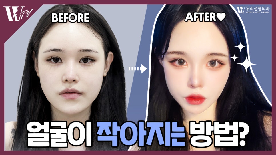 우리성형외과 임평진 원장) 얼굴이 작아지는 방법? 알려드립니다! 관련 이미지 1