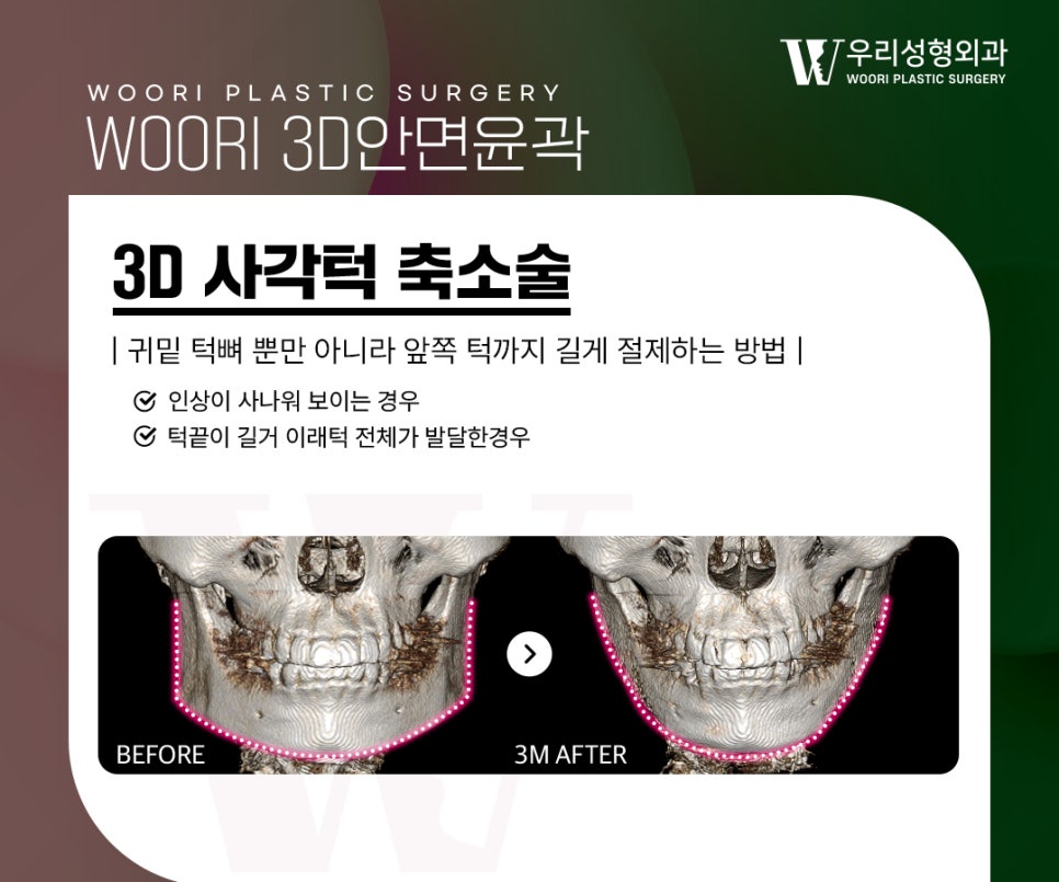 안면윤곽 제대로 알고 선택해야 하는 이유 관련 이미지 4