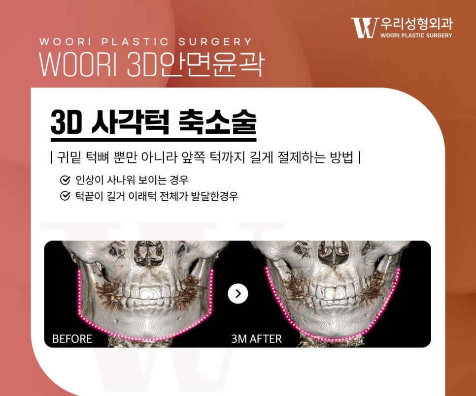 안면윤곽수술 얼굴 윤곽이 울퉁불퉁해 보이는 이유는? 관련 이미지 3