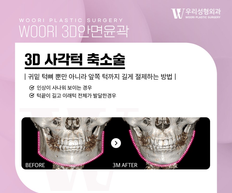 옆광대축소 후 얼굴이 더 작아 보이는 진짜 이유 관련 이미지 3