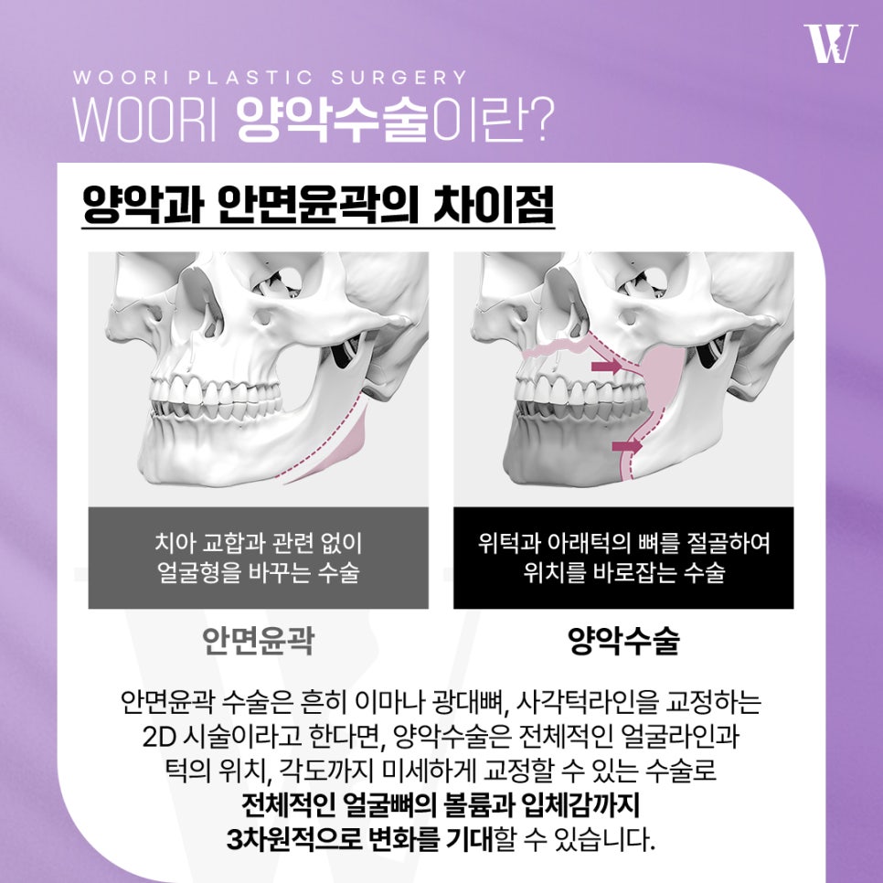 주걱턱교정 양악수술이 필요한 이유 관련 이미지 2