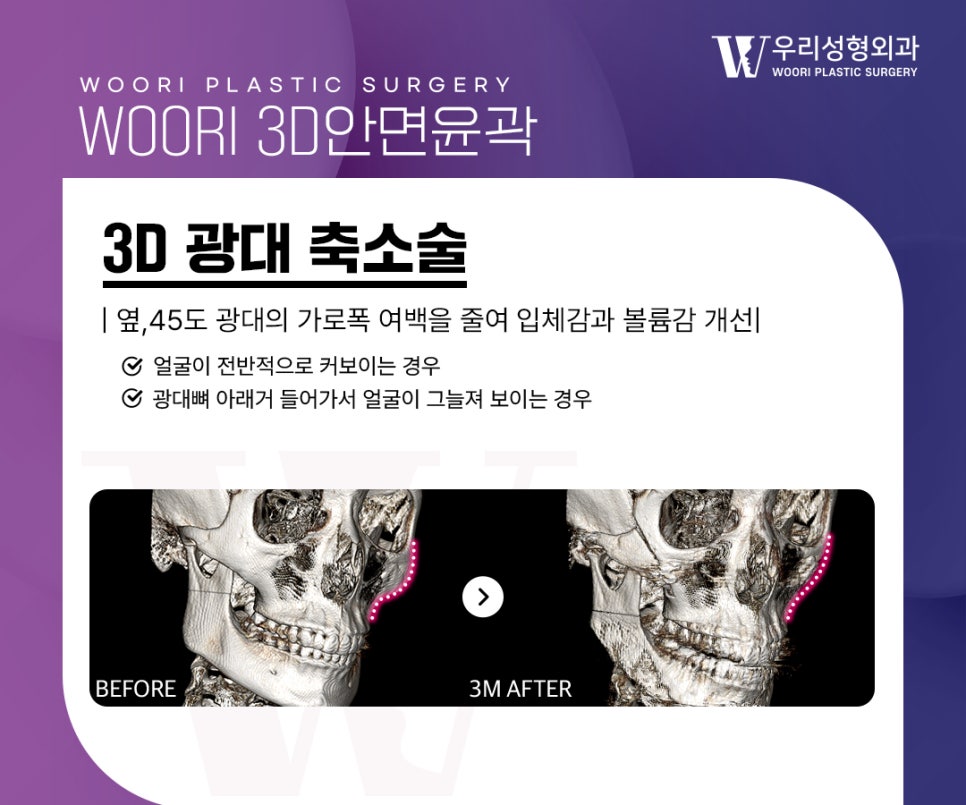 광대축소 윤곽수술 부위별 차이와 특징 관련 이미지 2