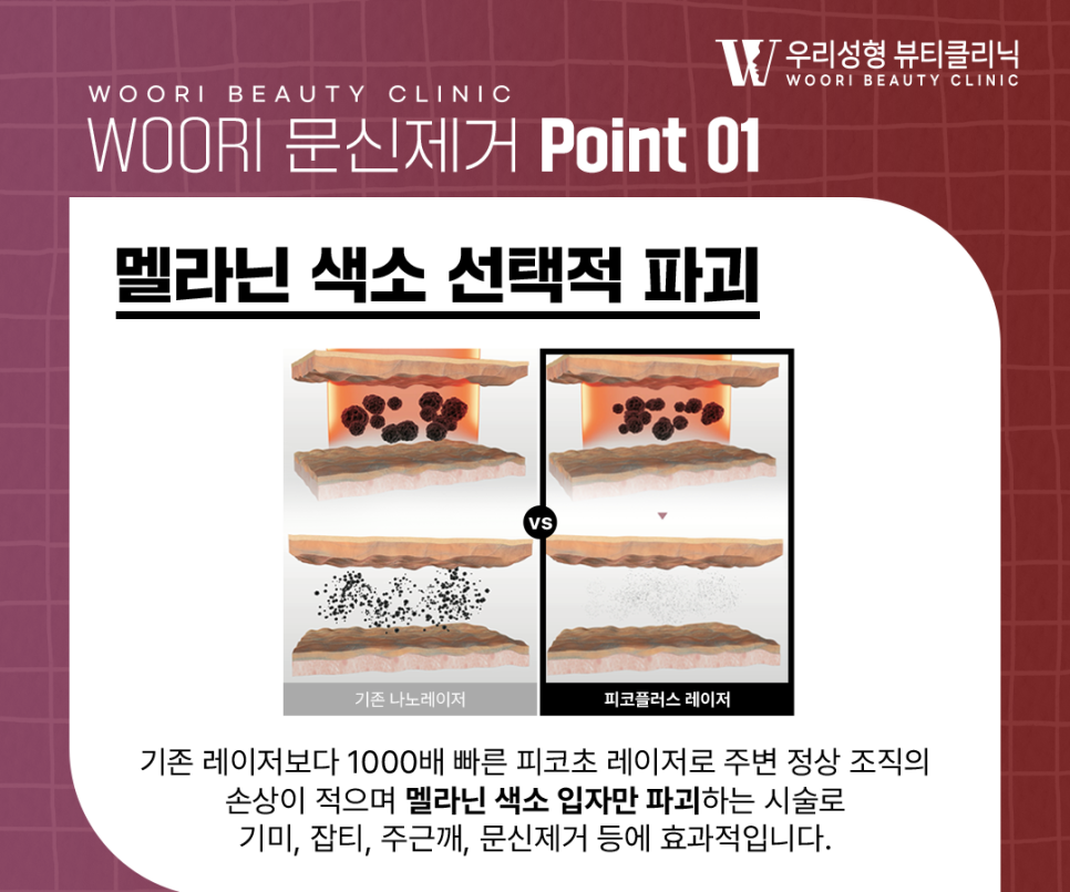 타투제거병원 지우는 원리부터 회복 과정까지 알아보자 관련 이미지 3