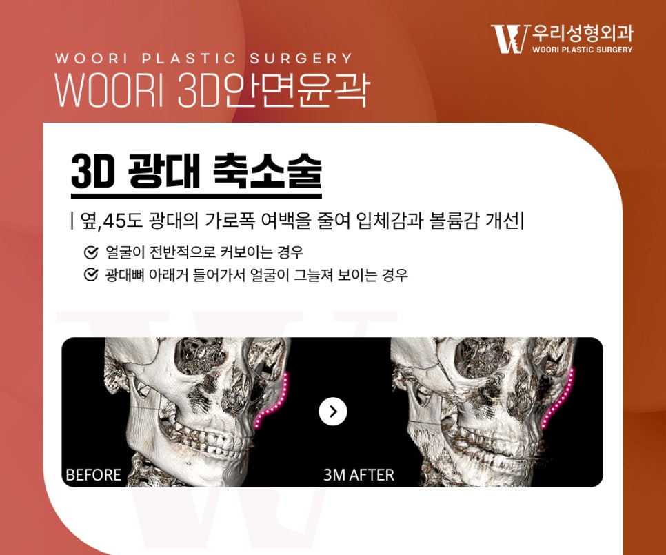 Cheekbone Reduction: Will Reducing Only the Lateral Cheekbones Make the Face Look Smaller? image 2