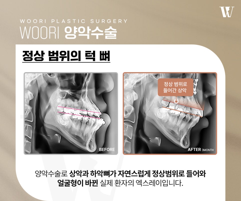 양악수술 안면윤곽으로 해결하기 어려운 골격 문제 관련 이미지 4
